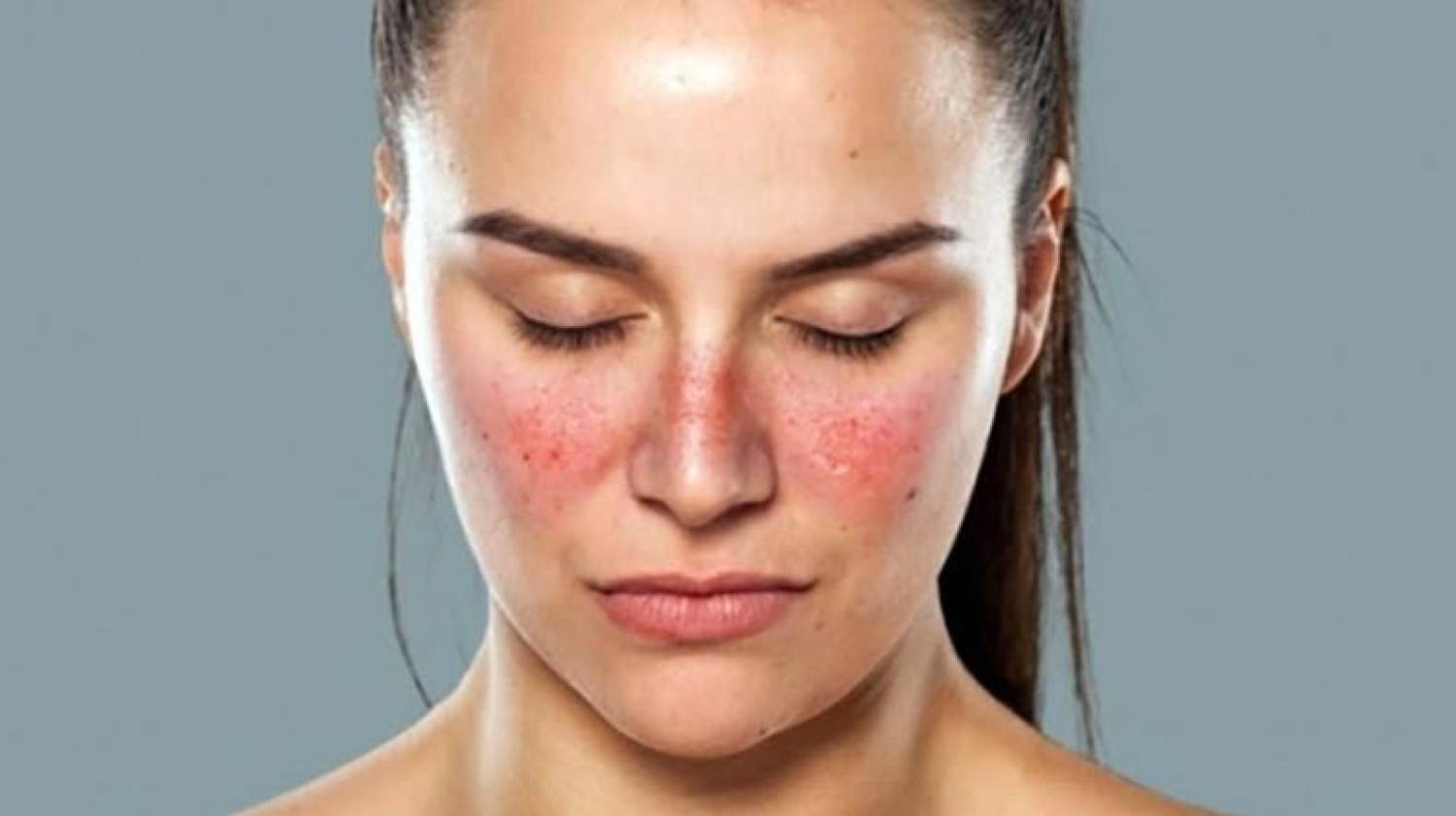 Justiça manda Santander reintegrar bancária demitida por ter lúpus Justiça manda Santander reintegrar bancária demitida por ter lúpus