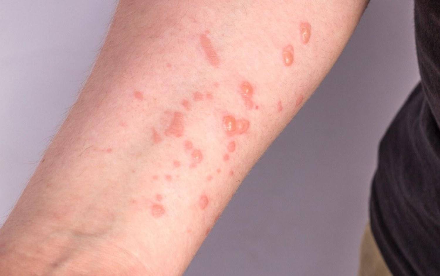 Campanha: sindicalistas cobram da Fenaban protocolos contra Monkeypox Campanha: sindicalistas cobram da Fenaban protocolos contra Monkeypox