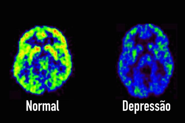 Conheça 7 sinais que podem indicar DEPRESSÃO